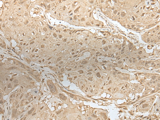 Immunohistochemistry of paraffin-embedded Human esophagus cancer tissue  using ZBTB18 Polyclonal Antibody at dilution of 1:50(×200)