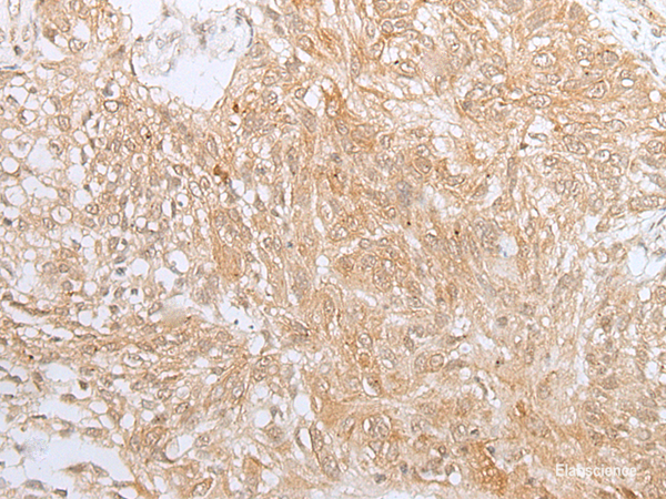 Immunohistochemistry of paraffin-embedded Human lung cancer tissue  using ZNF34 Polyclonal Antibody at dilution of 1:40(×200)