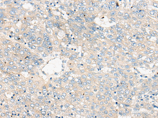 Immunohistochemistry of paraffin-embedded Human liver cancer tissue  using ZNF449 Polyclonal Antibody at dilution of 1:50(×200)
