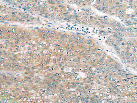 Immunohistochemistry of paraffin-embedded Human liver cancer tissue  using UBE2G2 Polyclonal Antibody at dilution of 1:55(×200)