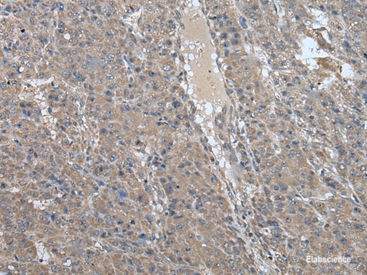 Immunohistochemistry of paraffin-embedded Human liver cancer tissue  using USP32 Polyclonal Antibody at dilution of 1:75(×200)