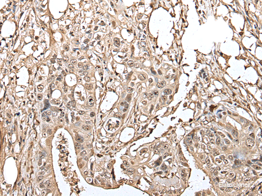Immunohistochemistry of paraffin-embedded Human colorectal cancer tissue  using UTP3 Polyclonal Antibody at dilution of 1:40(×200)