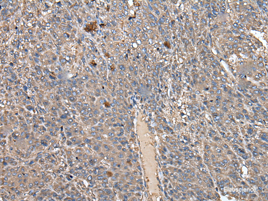 Immunohistochemistry of paraffin-embedded Human liver cancer tissue  using ATAD1 Polyclonal Antibody at dilution of 1:50(×200)
