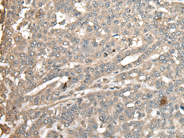 Immunohistochemistry of paraffin-embedded Human liver cancer tissue  using ATXN3 Polyclonal Antibody at dilution of 1:100(×200)
