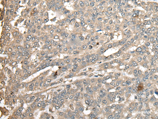 Immunohistochemistry of paraffin-embedded Human liver cancer tissue  using ATXN3 Polyclonal Antibody at dilution of 1:100(×200)
