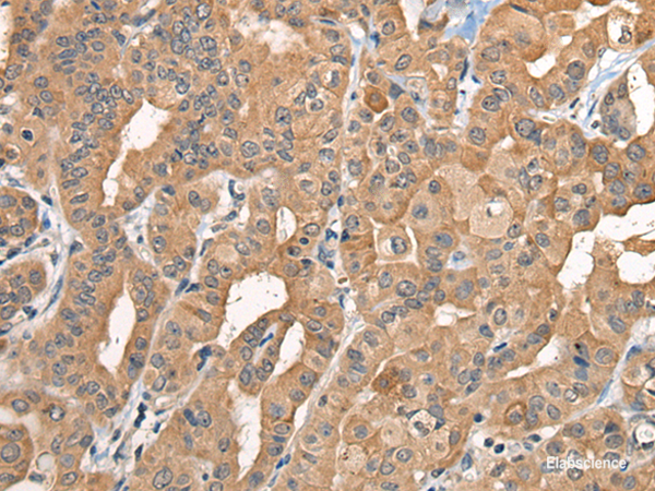 Immunohistochemistry of paraffin-embedded Human thyroid cancer tissue  using BCAN Polyclonal Antibody at dilution of 1:35(×200)