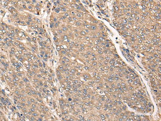 Immunohistochemistry of paraffin-embedded Human liver cancer tissue  using C17orf67 Polyclonal Antibody at dilution of 1:50(×200)