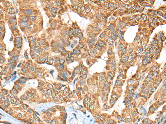 Immunohistochemistry of paraffin-embedded Human thyroid cancer tissue  using C1R Polyclonal Antibody at dilution of 1:70(×200)