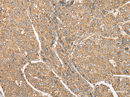 Immunohistochemistry of paraffin-embedded Human liver cancer tissue  using C5AR1 Polyclonal Antibody at dilution of 1:50(×200)
