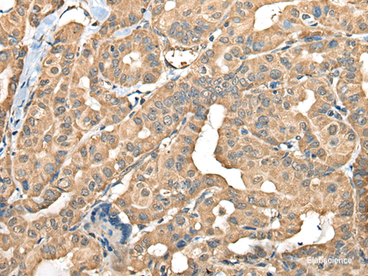 Immunohistochemistry of paraffin-embedded Human thyroid cancer tissue  using FAM110B Polyclonal Antibody at dilution of 1:40(×200)