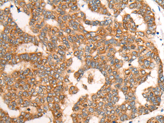 Immunohistochemistry of paraffin-embedded Human liver cancer tissue  using CDON Polyclonal Antibody at dilution of 1:65(×200)