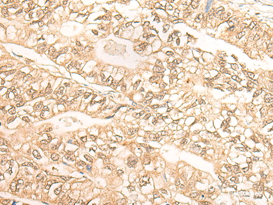 Immunohistochemistry of paraffin-embedded Human gastric cancer tissue  using DMC1 Polyclonal Antibody at dilution of 1:30(×200)