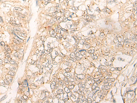 Immunohistochemistry of paraffin-embedded Human gastric cancer tissue  using CUTA Polyclonal Antibody at dilution of 1:40(×200)
