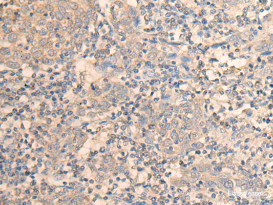 Immunohistochemistry of paraffin-embedded Human cervical cancer tissue  using DAZ1 Polyclonal Antibody at dilution of 1:55(×200)
