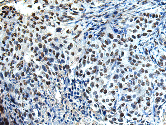 Immunohistochemistry of paraffin-embedded Human esophagus cancer tissue  using DDX39A Polyclonal Antibody at dilution of 1:65(×200)