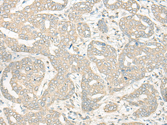 Immunohistochemistry of paraffin-embedded Human liver cancer tissue  using HLA-DRB5 Polyclonal Antibody at dilution of 1:45(×200)