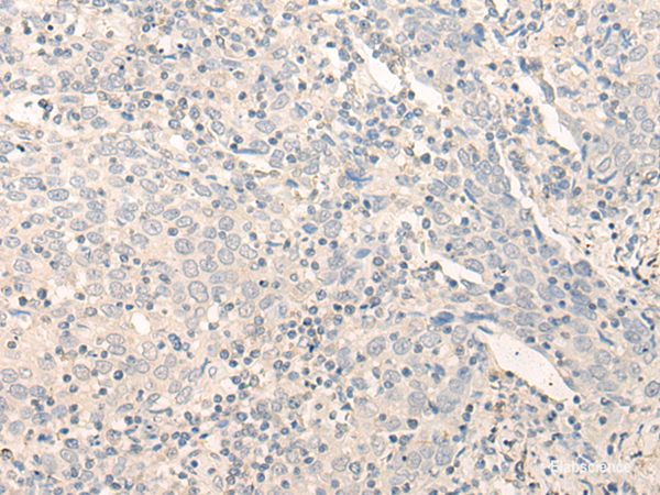 Immunohistochemistry of paraffin-embedded Human cervical cancer tissue  using RADIL Polyclonal Antibody at dilution of 1:40(×200)