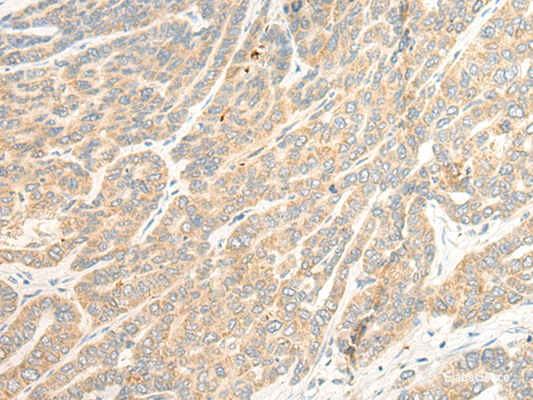Immunohistochemistry of paraffin-embedded Human liver cancer tissue  using TTC4 Polyclonal Antibody at dilution of 1:45(×200)