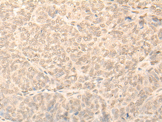 Immunohistochemistry of paraffin-embedded Human ovarian cancer tissue  using NARF Polyclonal Antibody at dilution of 1:45(×200)