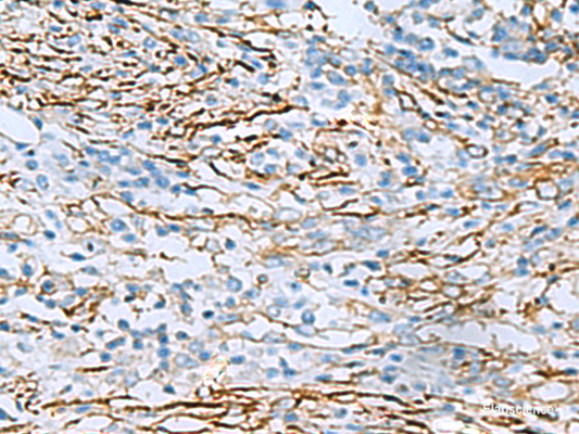 Immunohistochemistry of paraffin-embedded Human breast cancer tissue  using DPYSL3 Polyclonal Antibody at dilution of 1:55(×200)