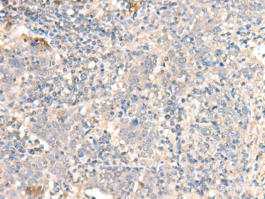 Immunohistochemistry of paraffin-embedded Human cervical cancer tissue  using PARS2 Polyclonal Antibody at dilution of 1:30(×200)
