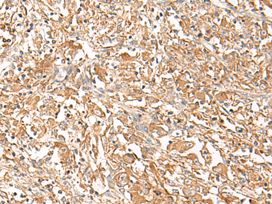 Immunohistochemistry of paraffin-embedded Human liver cancer tissue  using CORO2A Polyclonal Antibody at dilution of 1:50(×200)