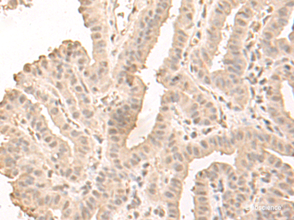 Immunohistochemistry of paraffin-embedded Human thyroid cancer tissue  using SAP130 Polyclonal Antibody at dilution of 1:50(×200)