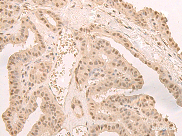 Immunohistochemistry of paraffin-embedded Human thyroid cancer tissue  using CNOT10 Polyclonal Antibody at dilution of 1:50(×200)