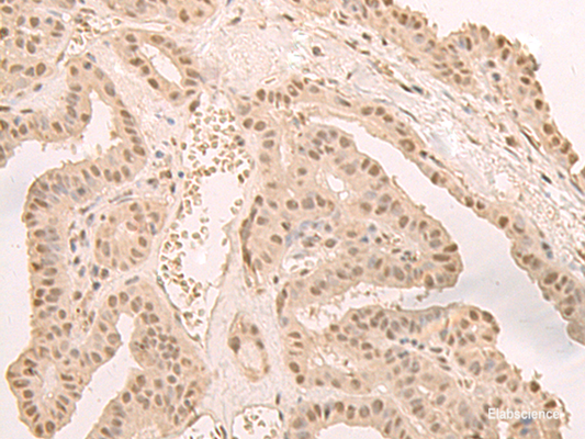 Immunohistochemistry of paraffin-embedded Human thyroid cancer tissue  using CNOT10 Polyclonal Antibody at dilution of 1:50(×200)