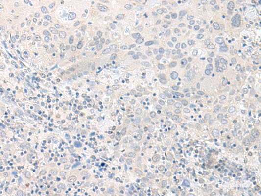 Immunohistochemistry of paraffin-embedded Human cervical cancer tissue  using TIMM8A Polyclonal Antibody at dilution of 1:50(×200)