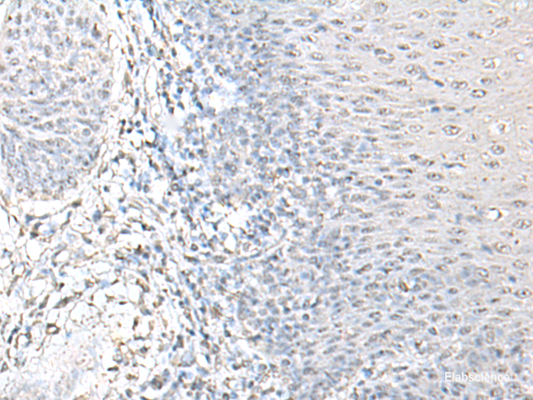 Immunohistochemistry of paraffin-embedded Human esophagus cancer tissue  using EPM2A Polyclonal Antibody at dilution of 1:55(×200)