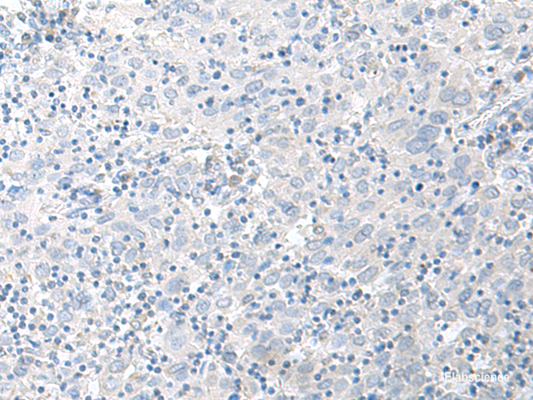 Immunohistochemistry of paraffin-embedded Human cervical cancer tissue  using STAU2 Polyclonal Antibody at dilution of 1:45(×200)