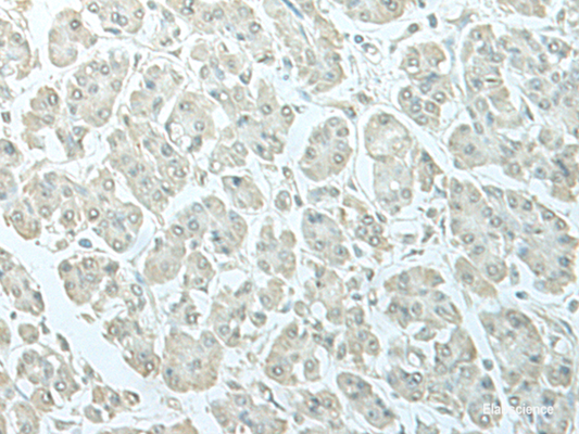 Immunohistochemistry of paraffin-embedded Human gastric cancer tissue  using C8orf4 Polyclonal Antibody at dilution of 1:55(×200)