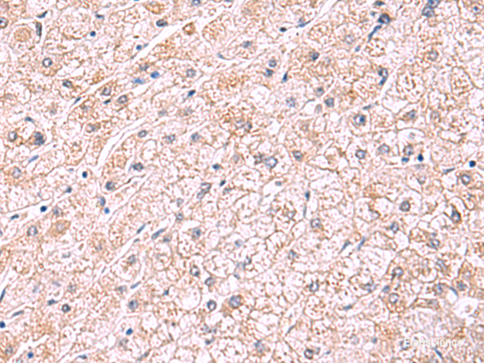 Immunohistochemistry of paraffin-embedded Human liver cancer tissue  using PDRG1 Polyclonal Antibody at dilution of 1:75(×200)
