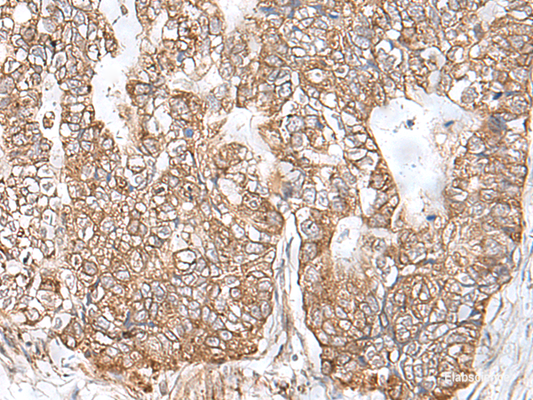 Immunohistochemistry of paraffin-embedded Human gastric cancer tissue  using RNF111 Polyclonal Antibody at dilution of 1:50(×200)