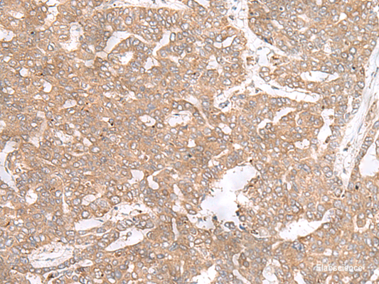 Immunohistochemistry of paraffin-embedded Human liver cancer tissue  using PTP4A3 Polyclonal Antibody at dilution of 1:40(×200)