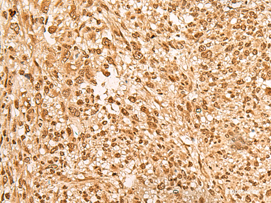 Immunohistochemistry of paraffin-embedded Human liver cancer tissue  using JPT2 Polyclonal Antibody at dilution of 1:65(×200)