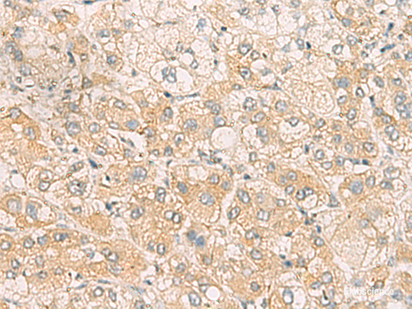 Immunohistochemistry of paraffin-embedded Human liver cancer tissue  using SYNGR1 Polyclonal Antibody at dilution of 1:60(×200)