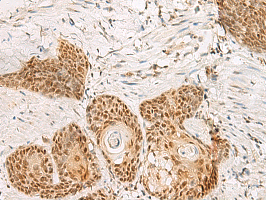 Immunohistochemistry of paraffin-embedded Human esophagus cancer tissue  using PSPC1 Polyclonal Antibody at dilution of 1:30(×200)