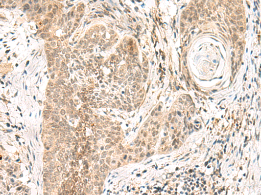 Immunohistochemistry of paraffin-embedded Human esophagus cancer tissue  using GPSM1 Polyclonal Antibody at dilution of 1:55(×200)