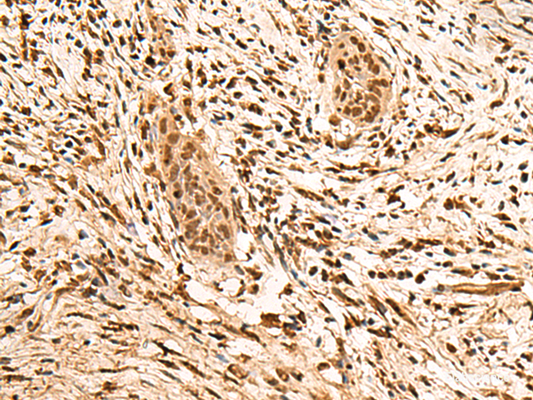 Immunohistochemistry of paraffin-embedded Human esophagus cancer tissue  using PPM1G Polyclonal Antibody at dilution of 1:40(×200)