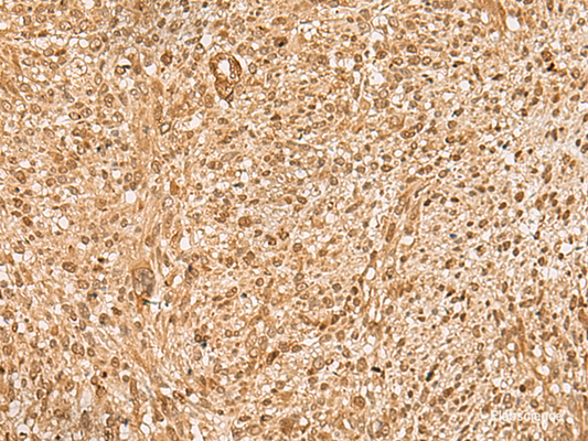 Immunohistochemistry of paraffin-embedded Human liver cancer tissue  using HIRIP3 Polyclonal Antibody at dilution of 1:60(×200)