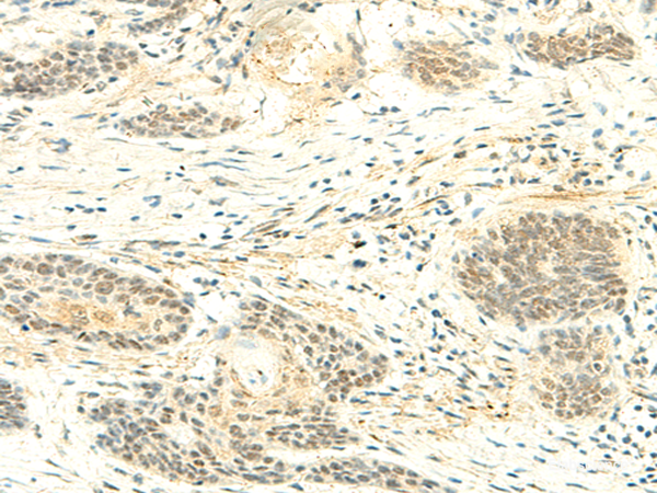 Immunohistochemistry of paraffin-embedded Human esophagus cancer tissue  using ATMIN Polyclonal Antibody at dilution of 1:50(×200)