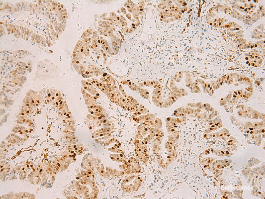 Immunohistochemistry of paraffin-embedded Human liver cancer tissue  using RFX6 Polyclonal Antibody at dilution of 1:50(×200)