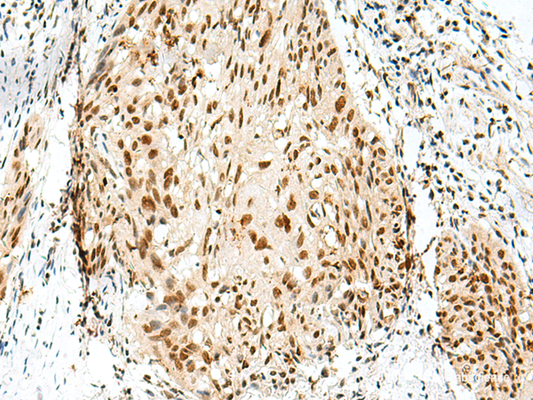 Immunohistochemistry of paraffin-embedded Human esophagus cancer tissue  using RBM10 Polyclonal Antibody at dilution of 1:55(×200)
