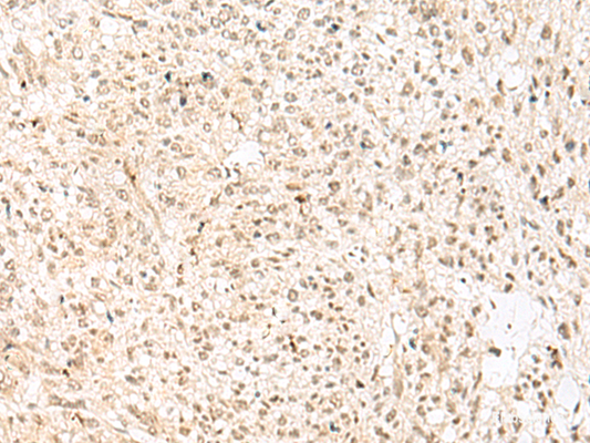 Immunohistochemistry of paraffin-embedded Human liver cancer tissue  using RBX1 Polyclonal Antibody at dilution of 1:50(×200)