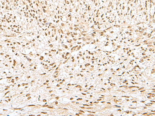 Immunohistochemistry of paraffin-embedded Human liver cancer tissue  using GTF2A2 Polyclonal Antibody at dilution of 1:30(×200)