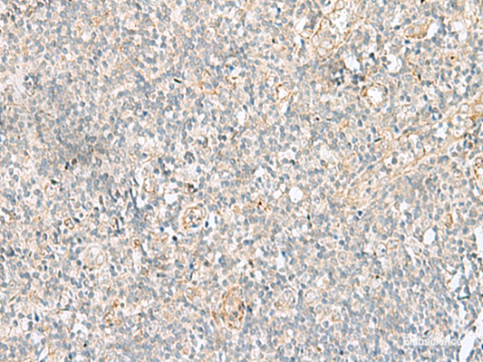 Immunohistochemistry of paraffin-embedded Human tonsil tissue  using GSKIP Polyclonal Antibody at dilution of 1:55(×200)