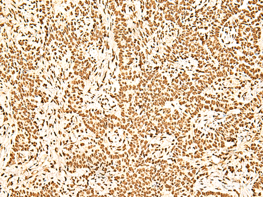 Immunohistochemistry of paraffin-embedded Human ovarian cancer tissue  using ILF3 Polyclonal Antibody at dilution of 1:60(×200)