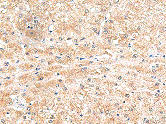 Immunohistochemistry of paraffin-embedded Human liver cancer tissue  using LRG1 Polyclonal Antibody at dilution of 1:50(×200)